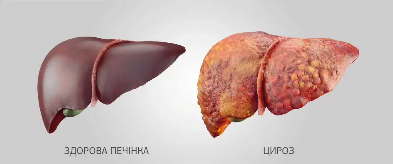 Зображення для новини Вірусні гепатити