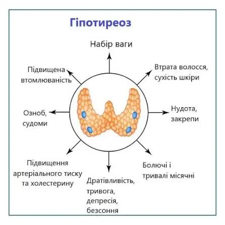 Зображення для новини Гіпотиреоз