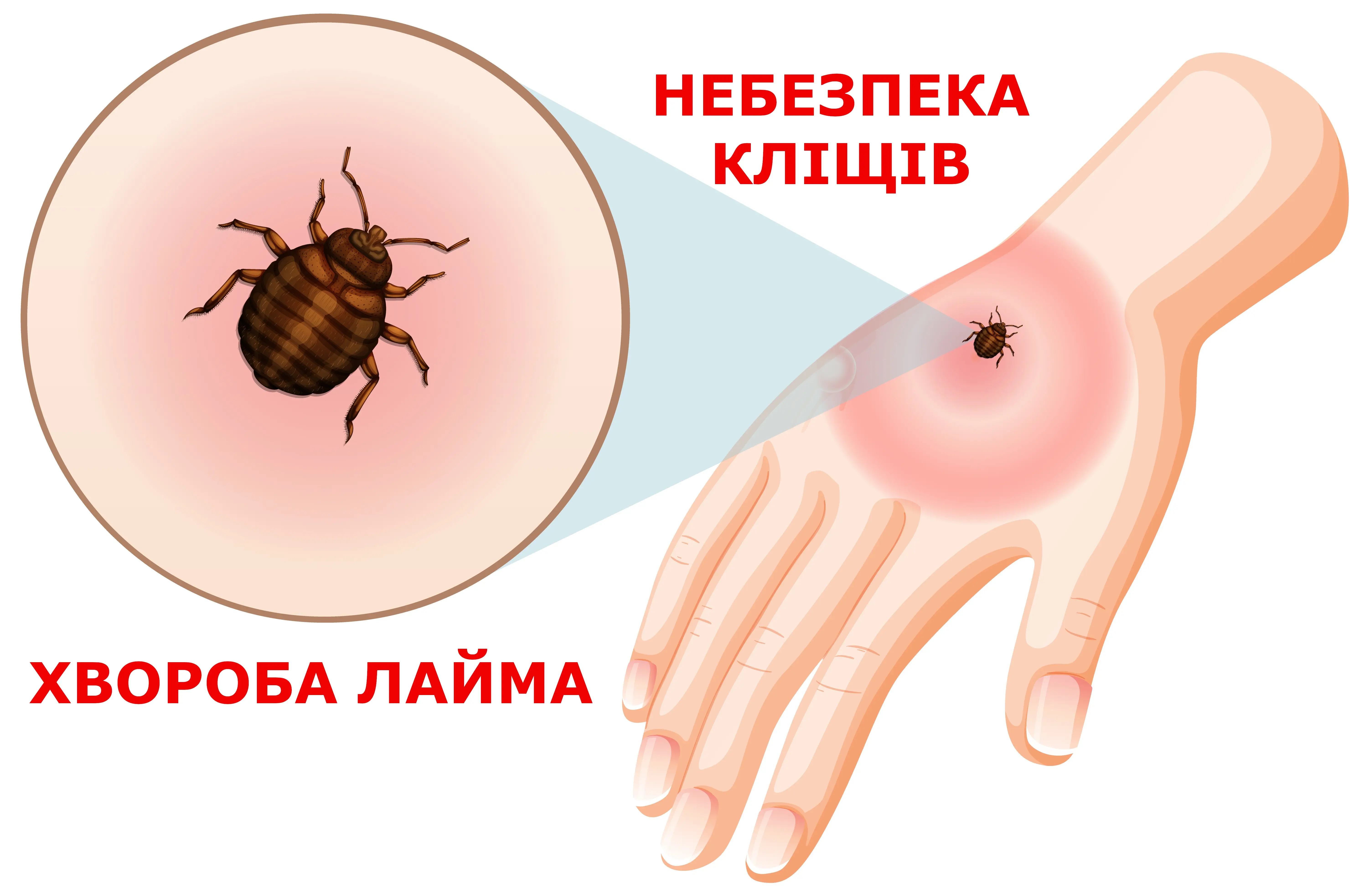 Зображення для новини Хвороба Лайма